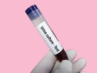 Urine sample for Culture and sensitivity test with color background.