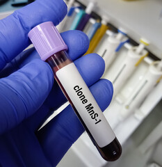Technician hold blood sample for Clone MnS1 blood test. Monoclonal Antibody test.