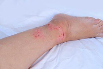 close-up injured female limb with damaged reddened skin, scratches, wound on painful female leg,...