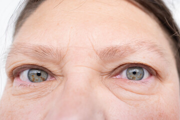 female eyes mature woman, close-up wrinkles, under eyes bags, swelling on lower eyelid, allergies,...