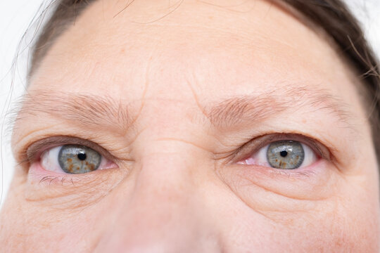 female eyes mature woman, close-up wrinkles, under eyes bags, swelling on lower eyelid, allergies, kidney disease, medical conditions