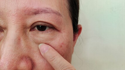 portrait showing the fingers holding the flabbiness and wrinkle under the eye, swelling and loose,...