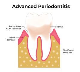 Advanced Periodontitis Science Design Vector Illustration Diagram