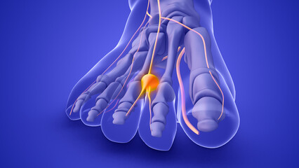 A Morton's neuroma on a foot nerve