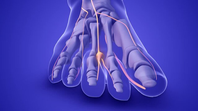 A Morton's neuroma on a foot nerve