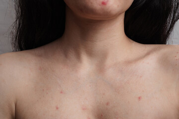 Close-up of the skin of the face and body of a woman with acne and other dermatological problems.