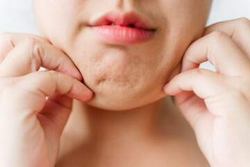 A woman with a puffy face and double chin.