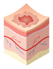 Skincare medical concept. Problems in cross-section of human skin horizontal layers structure. Anatomy illustrative model unhealthy layer of skin