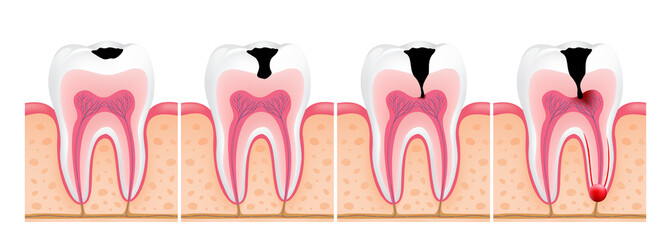 Stages of caries development. Enamel caries, Dentin caries, Pulpitis and Periodontitis. Dental care info-graphic, illustration.