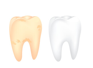 Dirty and clean tooth comparision on blue background.  Teeth Whitening. Dental care Concept. Oral Care, teeth restoration. Yellow and white teeth.