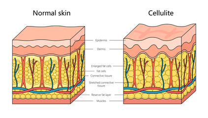 Human cellulite skin structure diagram hand drawn schematic raster illustration. Medical science educational illustration