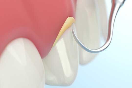 tartar removal tool removing dental calculus sticking on teeth and gums. 3D rendering.