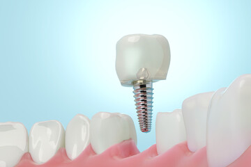 Molar teeth implant with blue science background. 3D rendering.