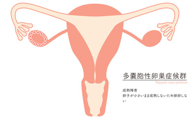 多嚢胞性卵巣症候群（成熟障害）の図解イラスト、子宮・卵巣の解剖図