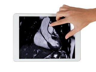 Cardiac MRI images  on Tablet are instrumental in assessing cardiac health, identifying heart...