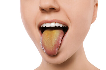 Gastrointestinal diseases. Woman showing her yellow tongue on white background, closeup