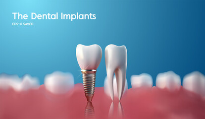 White tooth implant implant cut, healthy tooth or dental surgery. vector illstration. - obrazy, fototapety, plakaty