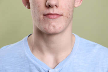 Fototapeta premium Young man with acne problem on olive background, closeup