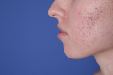 Young woman with acne problem on blue background, closeup. Space for text