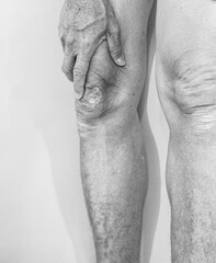 body parts Calluses and rough skin on legs and knees. of the elderly with muscle inflammation and bone degene.. - obrazy, fototapety, plakaty