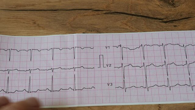 The cardiologist doctor is looking at the patient's electrocardiogram ECG (EKG)