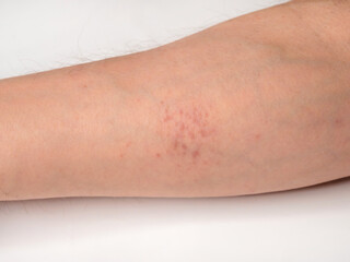 Red rash - skin reactions on the skin on male forearm.