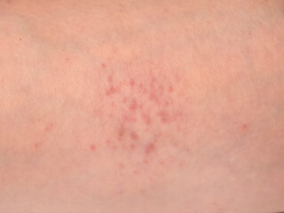 skin reactions on the skin on male forearm