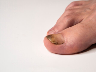 Inflamed and broken male toenail on white background.