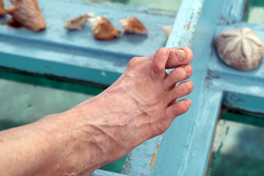woman's hammertoe and bunion
