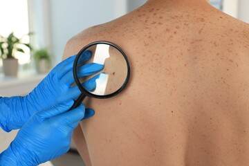 Dermatologist examining patient's birthmark with magnifying glass in clinic, closeup