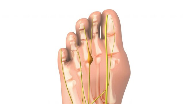 Pinched nerve or neuroma medical animation
