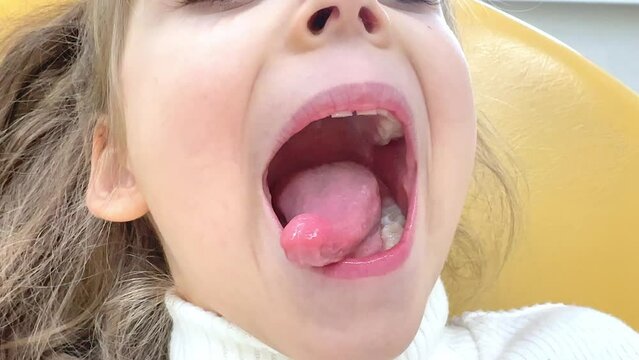 Close-up of little girl opening her mouth wide to the doctor to show her throat. Child is sitting with wide open mouth, with a tongue stuck out, clear view on the uvula and the soft palate