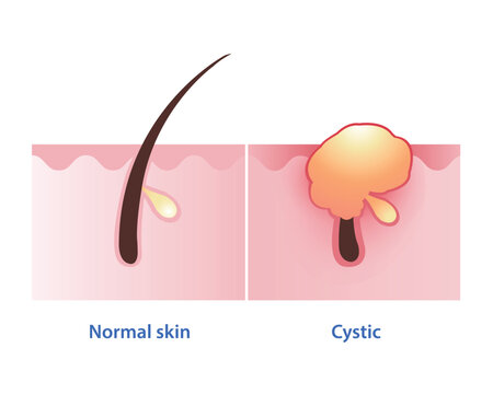 Cystic acne, the most severe type of inflammatory acne vector on white background. Normal skin and cyst develop pus filled pimple deep under the skin, often painful, large and to cause scarring.