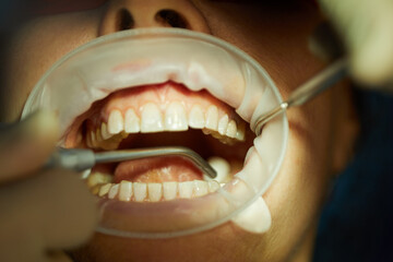 Close-up open mouth with lips holder and dental instruments.