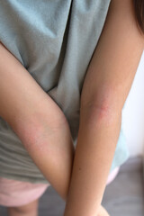 a girl shows her combed dry skin on the bend of her elbow, redness, roughness, itching from atopic dermatitis, the girl s face is not visible, vertical photo