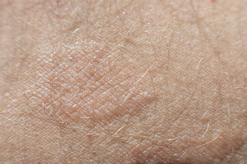 Large plaque parapsoriasis on caucasian man legs