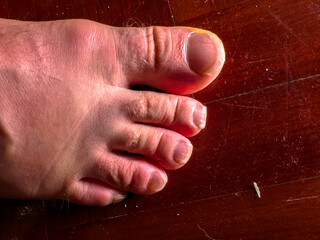 Neglected Toenail Care Close-up foot