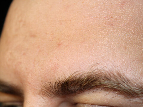 The forehead of a man with thick eyebrows and acne scars on the skin. Dermatology stock photo in best quality.