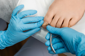The podologist cut ingrown toenail with nippers. Toe nail dressing. 