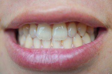 Close up photo of a woman's teeth containing tartar dental plaque