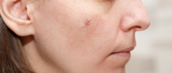 Real scar on the young woman face, scar on the cheek after a mole removal surgery. Scar after plastic surgery