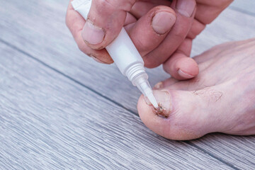 applying an antifungal agent to the toenail of the affected by the fungus close-up, the foreground...