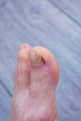 applying an antifungal agent to the toenail of the affected by the fungus close-up, the foreground...