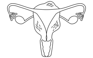Diagrammatic illustration of adenomyosis, anatomy of the uterus and ovaries