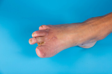 Amputation of diabetic toes of a person on a blue background. Selective focus. - obrazy, fototapety, plakaty