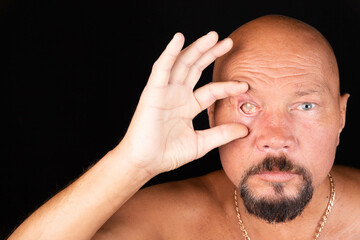 Glaucoma, dry eye, consequences. Portrait of a man