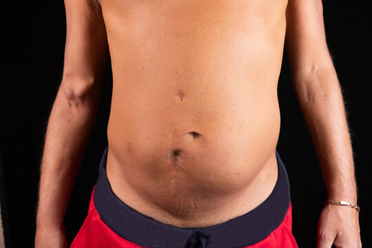 A man's body with scars from peritoneal dialysis and a transplanted kidney. Fistula on the arm from hemodialysis.