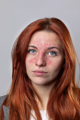 Caucasian model suffering from facial rosacea