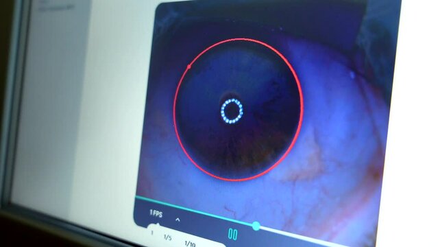 Screen used by the ophthalmologist to monitor the eye for laser application during glaucoma treatment in a patient