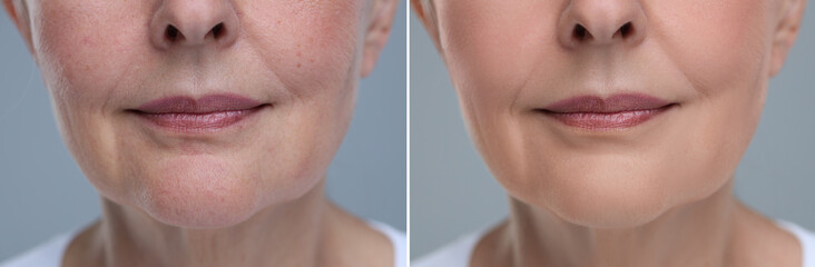 Aging skin changes. Collage with photos of mature woman before and after cosmetic procedure on grey background, closeup
